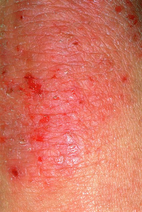 Eczema Photograph By Dr P Marazzi Science Photo Library