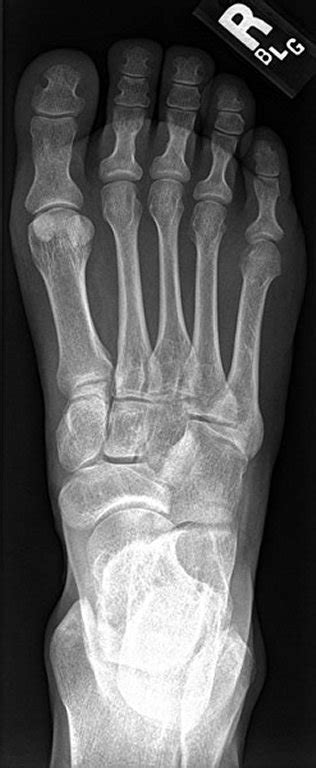 AP foot x-ray anatomy Diagram | Quizlet