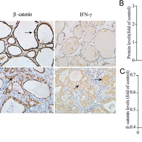 β Catenin And Ifn γ Expression In Ht Tissues And Goiter Adjacent Normal Download Scientific