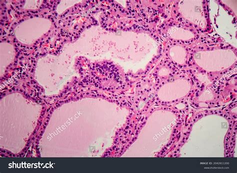 Endemic Goiter Light Micrograph Abnormal Enlargement Stock Photo