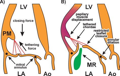 Mechanism Of Functional Mitral Regurgitation A Balance Of Closing