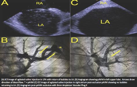 Cryptogenic Stroke With Positive Bubble Study And No Intracardiac Shunt