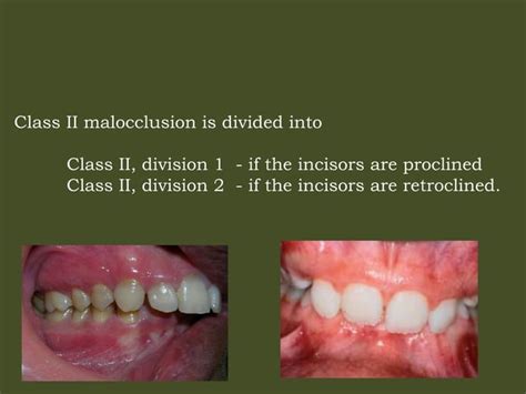 Class Ii Malocclusion Ppt