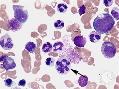 Hypersegmented neutrophil - 1.