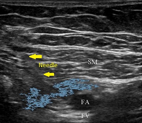 Adductor Canal Block Catheter