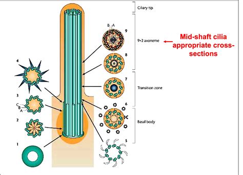 Primary Ciliary Dyskinesia (PCD) – Exploring Pediatric Pathology