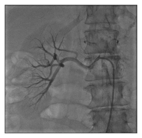 Catheter Based Renal Artery Denervation Procedure Download Scientific Diagram