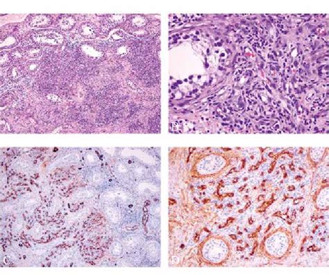 Figure 7 From Capillary Hemangioma Of The Testis A Case Report Of A