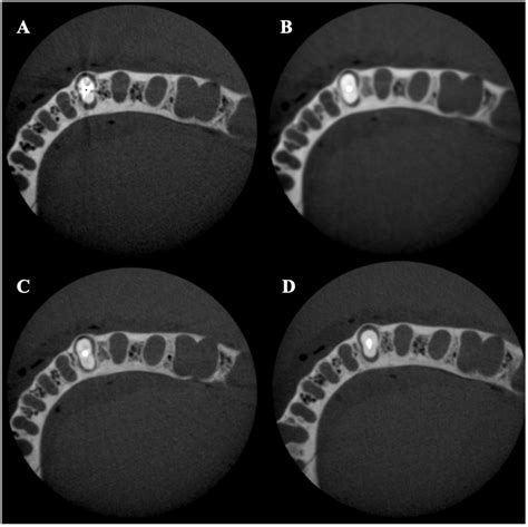 Tomography Free Full Text Comparative Evaluation Of Artifacts Originated By Four Different