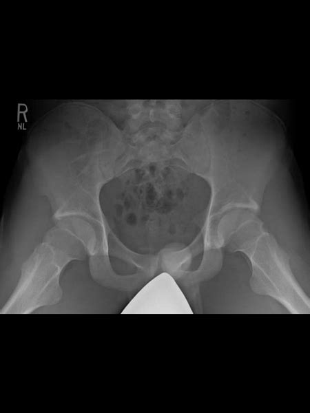 Year Old Hockey Player With Right Hip Pain And Fai With Cam Cllc