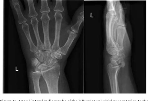 Figure From Acute Calcific Periarthritis Secondary To Calcium