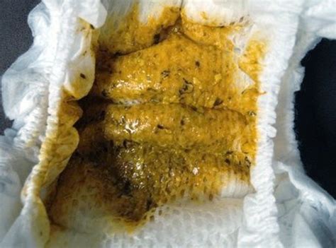 Black Specks in Stool | Medical Point