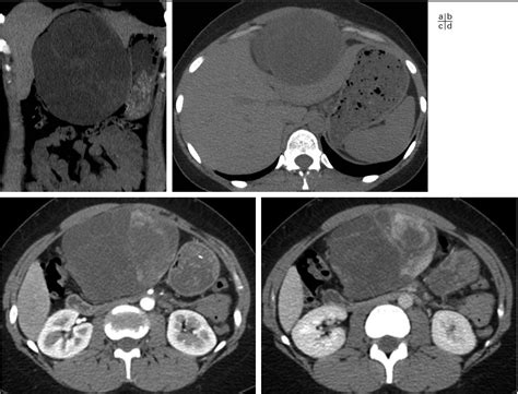 Figure 1 From Poorly Differentiated Myxoid Sarcoma Of The Round