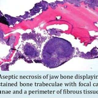 Aseptic necrosis of bone with necrotic adipose tissue, calcified ...