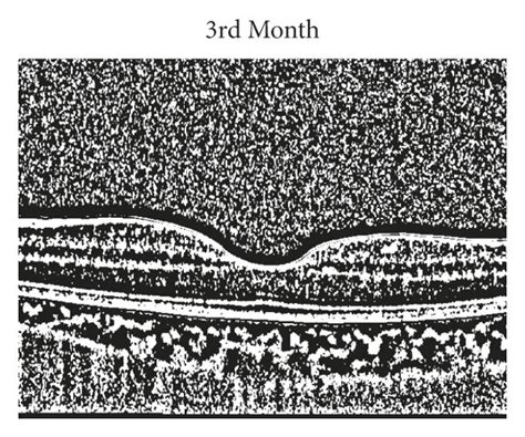 Choroidal Vascular Index Cvi The First Column Ac Shows The