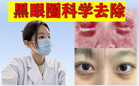 【黑眼圈熊猫眼深眼袋】不是所有的黑眼圈都是熬夜熬出来的！陈年熊猫眼睡再多也缓解不了！【皮肤科医生】教你3步高效淡化黑眼圈，实现眼周白净平坦