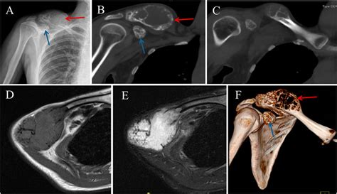 Frontiers Case Report Intraosseous Hemangioma Of The Lateral