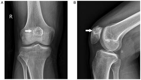 X Ray Images Showing An Osteolytic Lesion At The Medial Superior