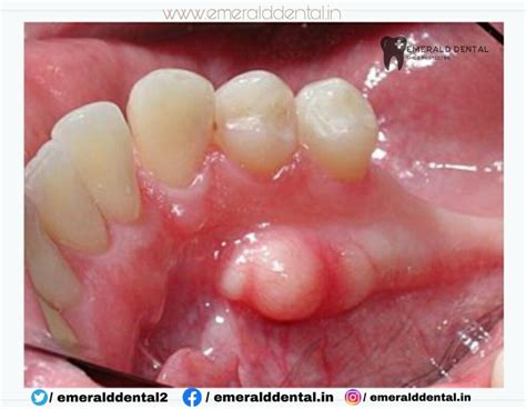 Torus Mandibularis Emerald Dental