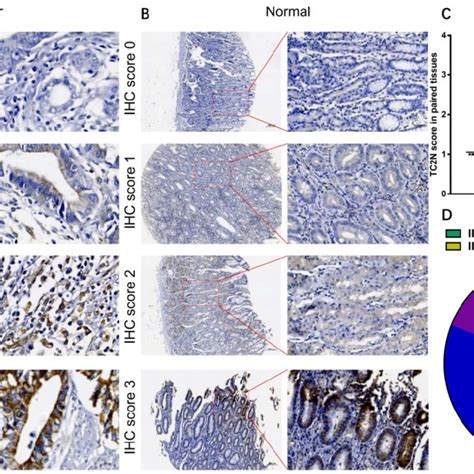 Tc N Protein Expression In Gc Tissues And Adjacent Normal Tissues A