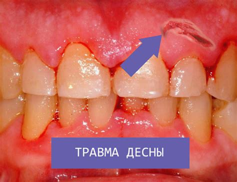 Травмированная и поцарапанная десна - что делать при повреждении