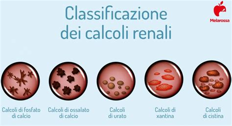 Calcoli Renali Cosa Sono Sintomi Cause Cura E Prevenzione