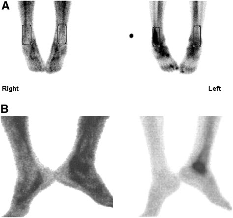 Osteomyelitis Bone Scan