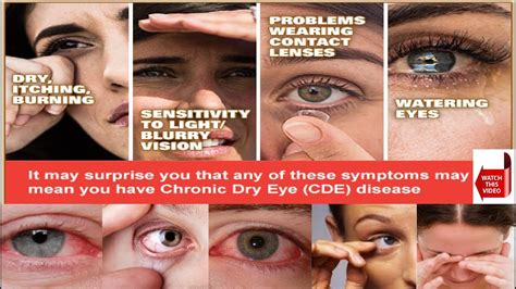 Dry Eye Syndrome Patient Education And Information Causes Symptoms