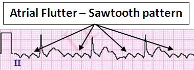 Atrial Flutter ECG Review Criteria And Examples LearntheHeart