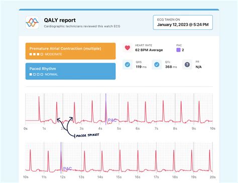 What Paced Rhythm Looks Like On Your Watch Ecg Qaly