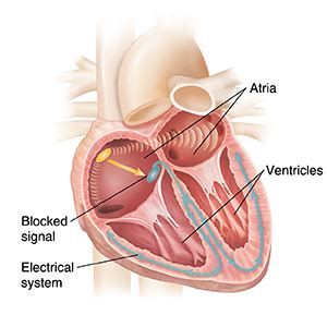 Understanding Third-Degree Heart Block | Saint Luke's Health System