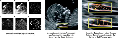 frontiers artificial intelligence  obstetric ultrasound  update