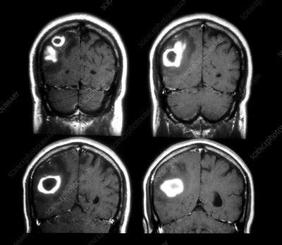 MRI of Staphylococcus Abscess - Stock Image - M108/0767 - Science Photo Library