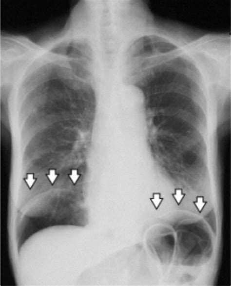 Pneumoperitoneum On Chest X Ray