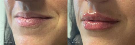 Restylane Kysse Before And After Lip Filler Patient 6797 Dr Randy