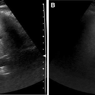 Diffuse Hepatic Steatosis With Nodular Fatty Sparing A 40 Year Old