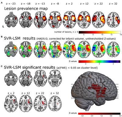 Frontiers Associations Of Lesion Location Structural Disconnection