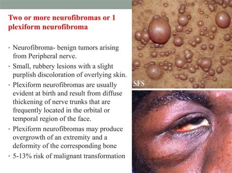 Neurocutaneous syndrome