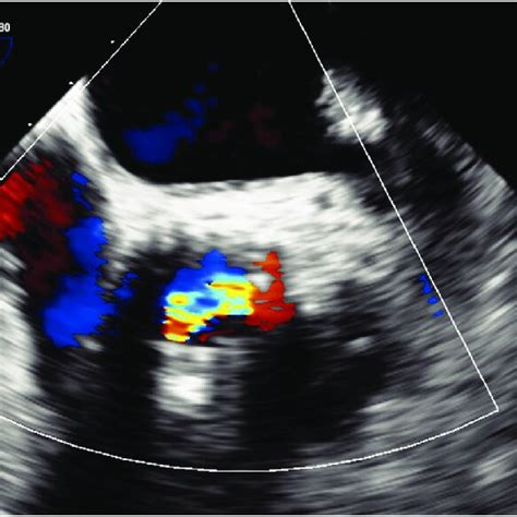 Preoperative Transesophageal Echocardiography Revealed Severe Ar And Download Scientific