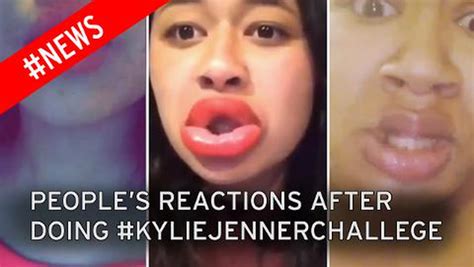 Kylie Jenner lip challenge goes wrong: Seriously injured fans post graphic images of scary trend ...