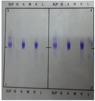 Immunofixation results. Quantitative immunoglobulins performed by ...