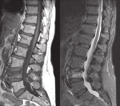 A A Sagittal T1 Weighted Magnetic Resonance Image Revealing A