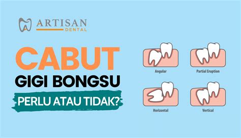 Cabut Gigi Bongsu - Perlu atau tidak? - Artisan Dental