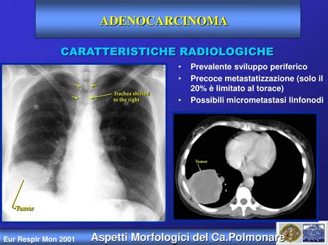 Ppt Diagnosi E Stadiazione Del Tumore Polmonare Powerpoint