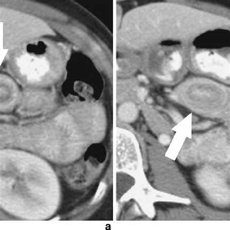 Ileal Intussusception In A Year Old Man With Small Bowel Obstruction