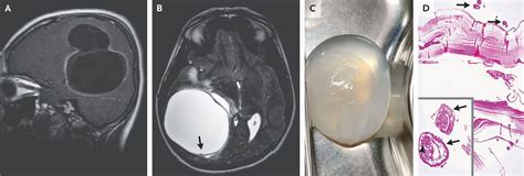 Cerebral Cystic Echinococcosis Medizzy