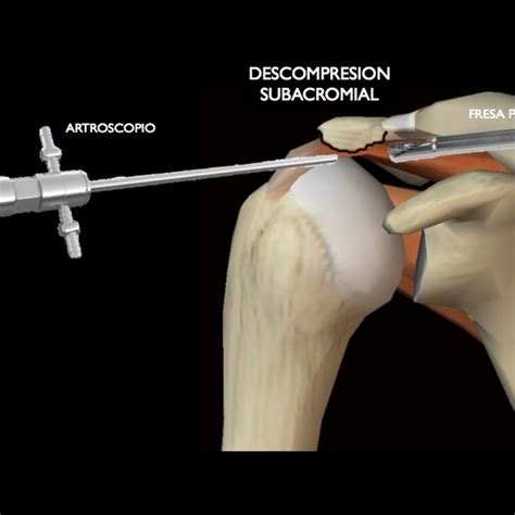 Pinzamiento Subacromial Dr Gustavo Armando Tafoya Arregu N