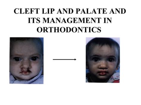 Cleft Lip And Palate Management In Orthodontics Ppt