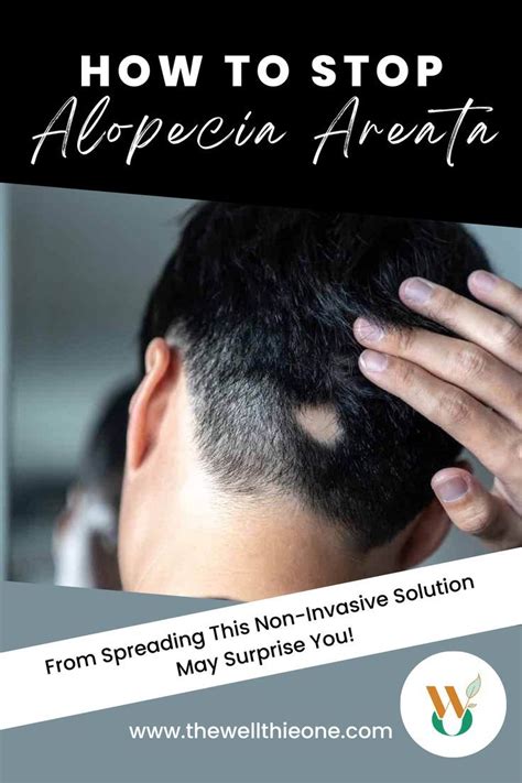 How To Stop Alopecia Areata From Spreading This Non Invasive Solution