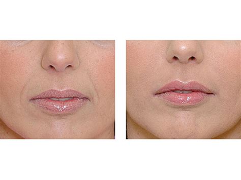 Natural Lip Fillers London Lip Injections Lip Augmentation London Clinic